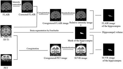 Use of an Automated Quantitative Analysis of Hippocampal Volume, Signal, and Glucose Metabolism to Detect Hippocampal Sclerosis